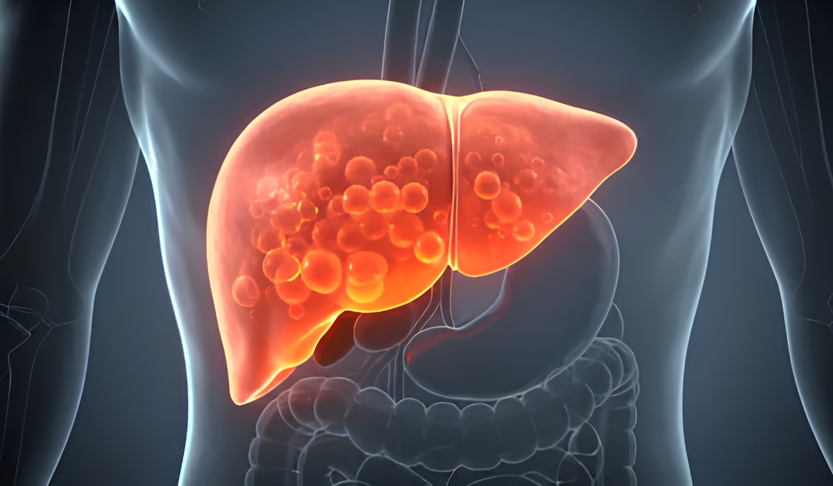  Fatty Liver Disease: What to Eat and How to Protect Your Liver 